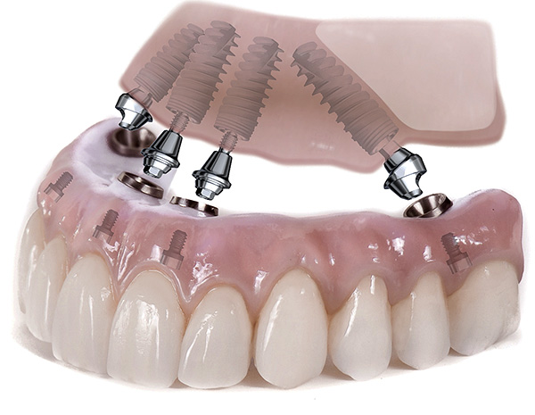 Un exemple de prothèses de toutes les dents de la mâchoire supérieure sur implants utilisant la technologie All-on-4.