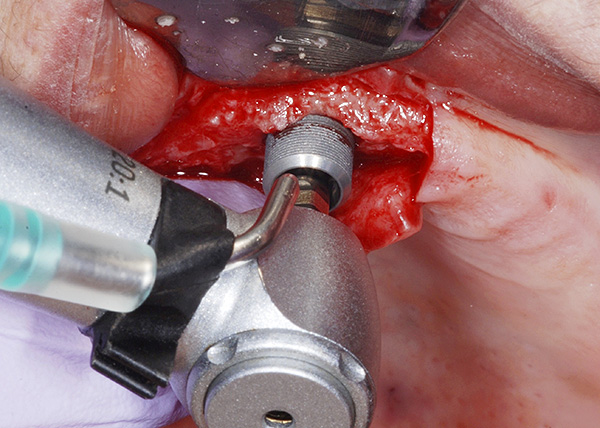 L'inconvénient de l'implantation dentaire est une période de rééducation assez longue après la chirurgie.