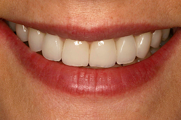 Dans la grande majorité des cas, l'utilisation d'implants dentaires présente bien plus d'avantages que l'installation d'un bridge.