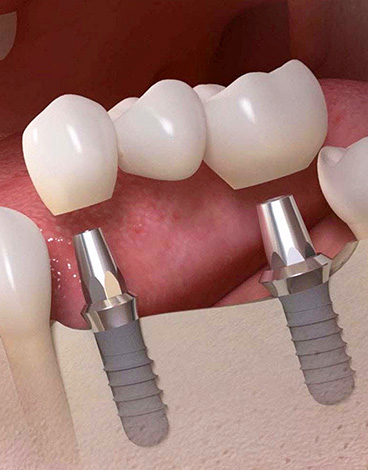 Le bridge peut également être installé sur des implants dentaires ...