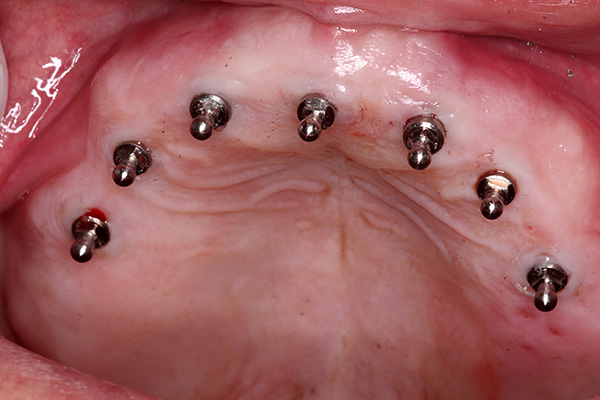 Voyons quels sont les avantages de l'utilisation de mini implants pour les prothèses dentaires ...