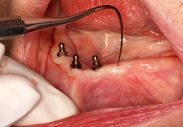 L'installation de mini implants est moins traumatisante que l'installation d'implants classiques.